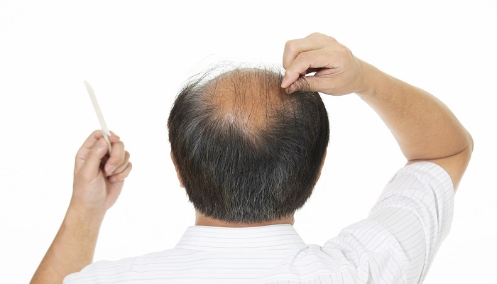 做梦梦见头发掉了秃了一块是什么意思 做梦梦见头发掉了秃了一块有什么预兆